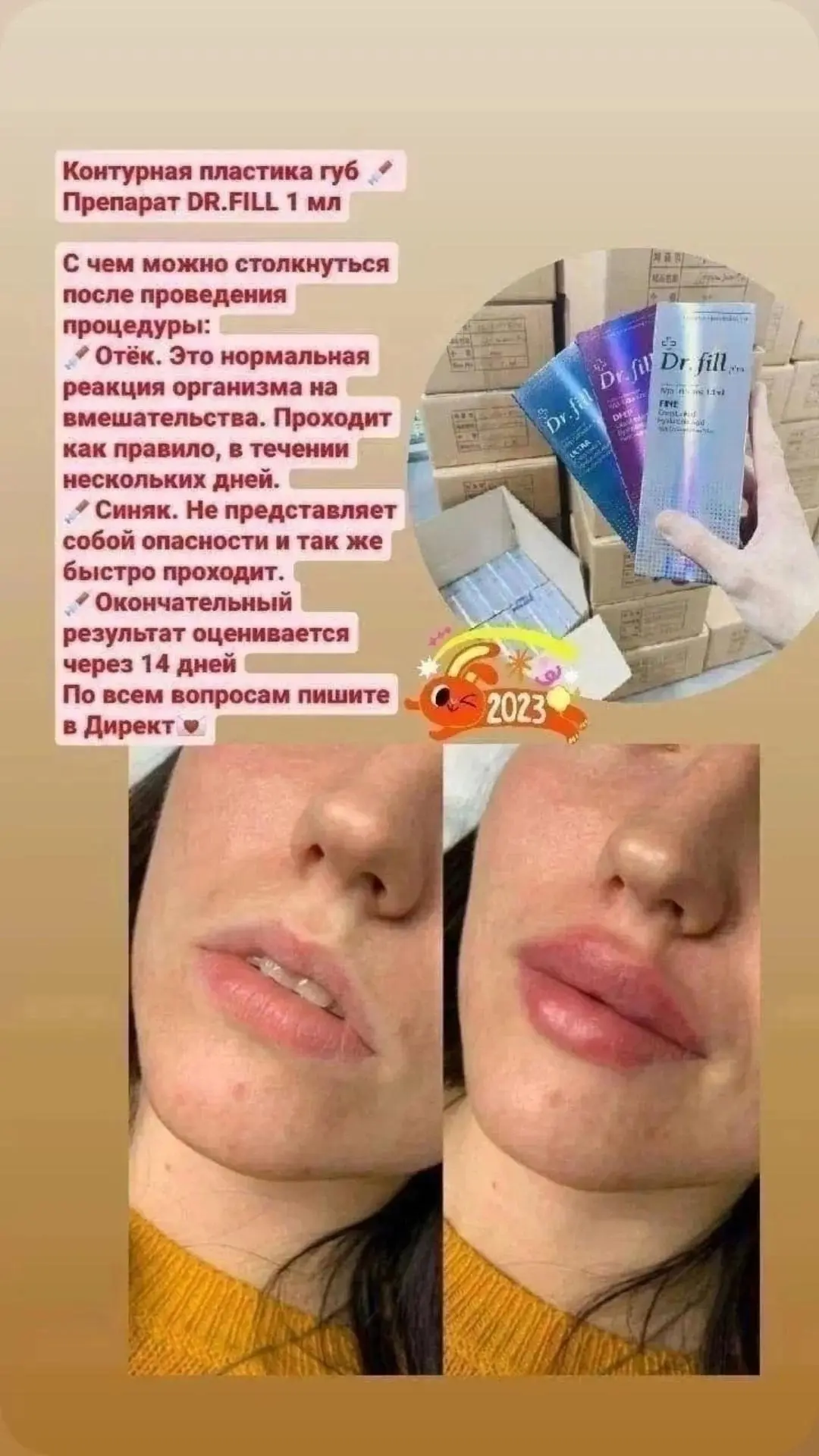 Нужны  модели на увеличение губ ✅