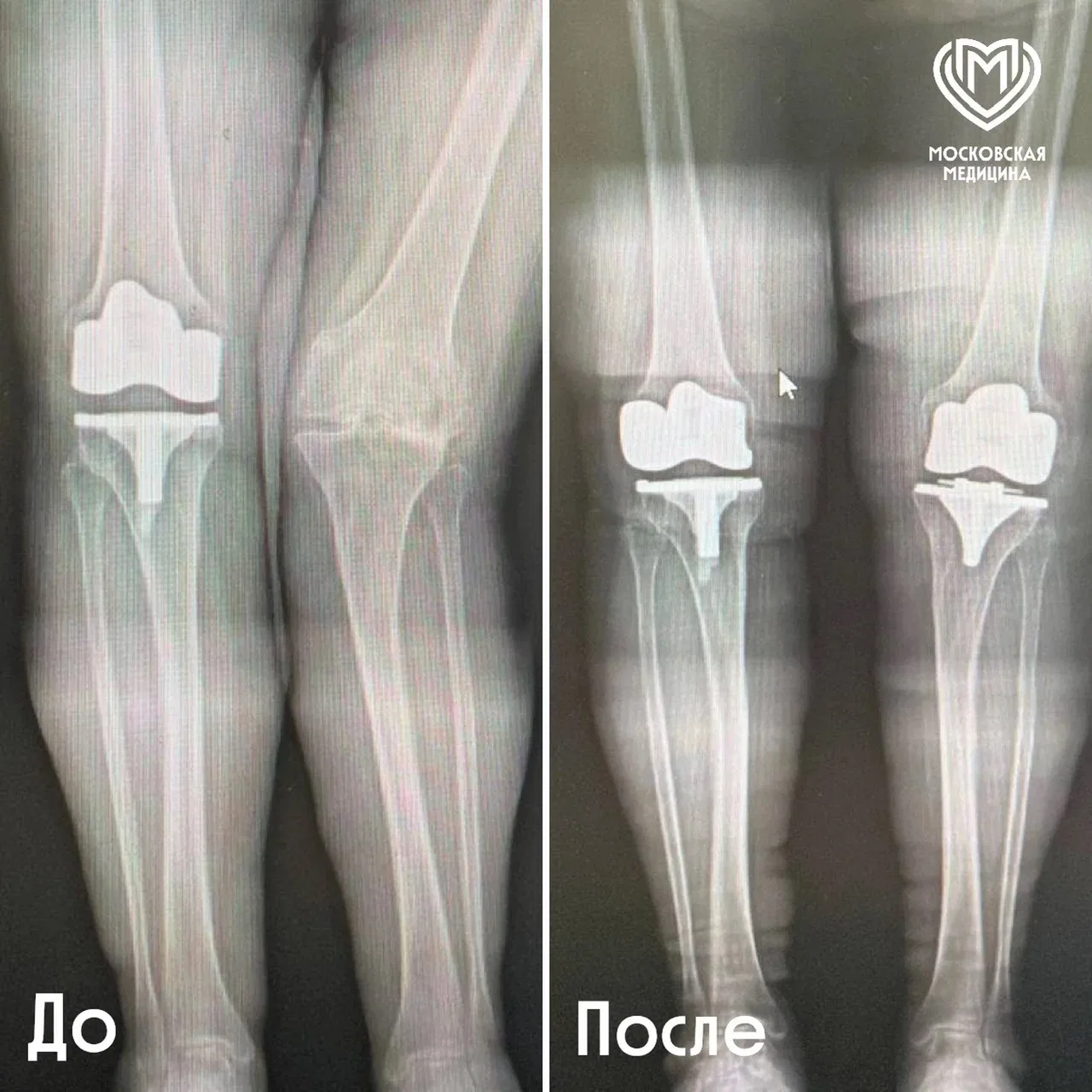 Одно колено — внутрь, другое — наружу: московские врачи помогли женщине с редкой патоло...