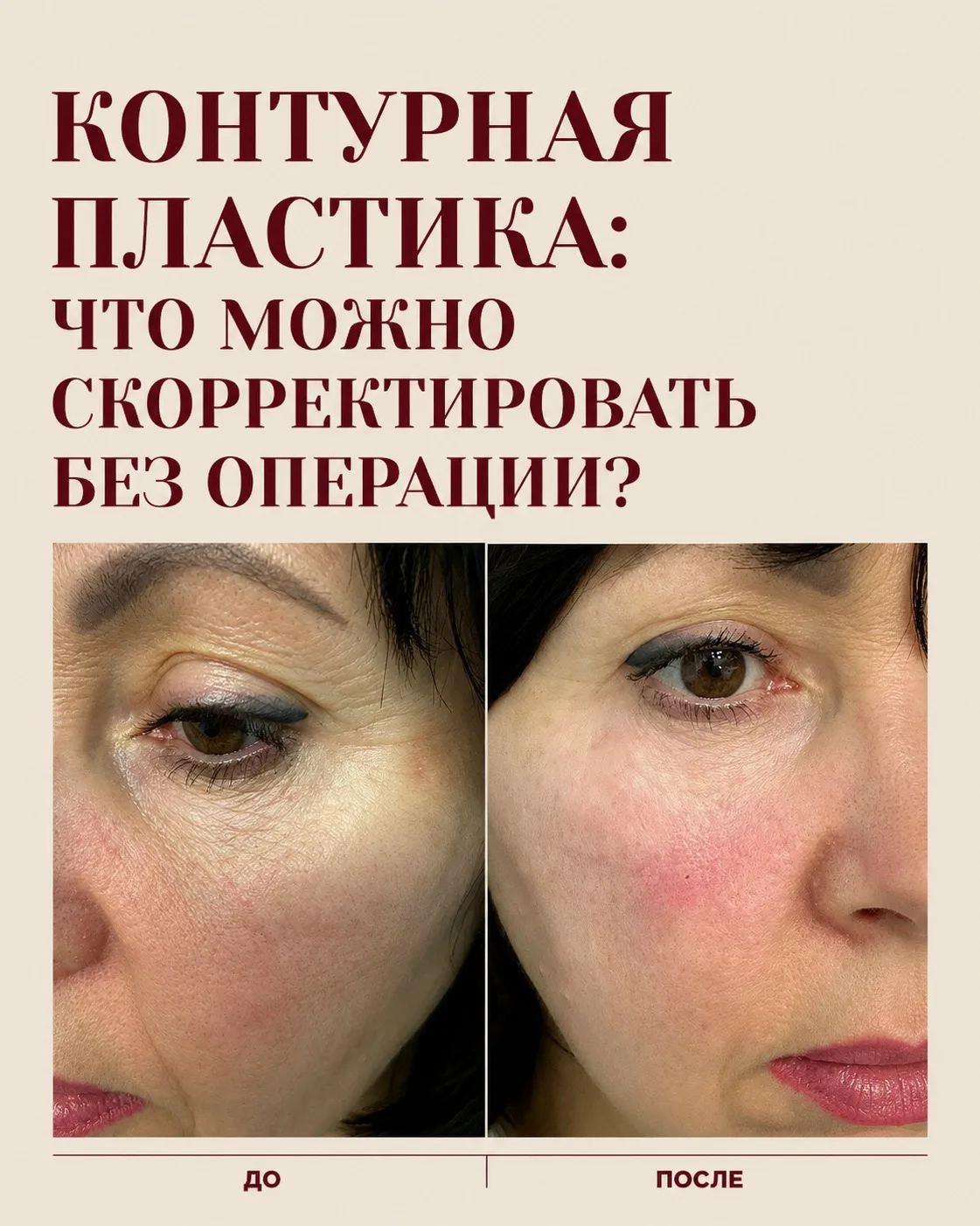 Иногда усталый вид создают не выраженные возрастные изменения, а отдельные детали. Одна...