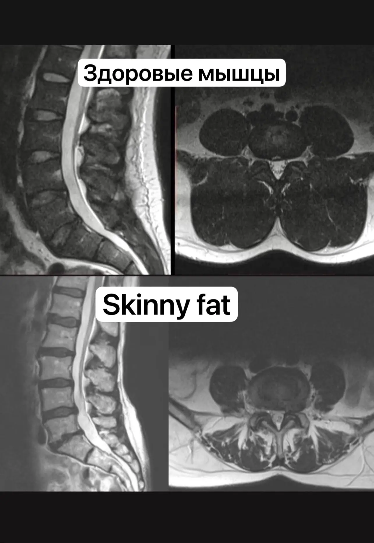 Вот, что происходит под кожей у девушек с фигурами skinny fat (стройная, не толстая, но...