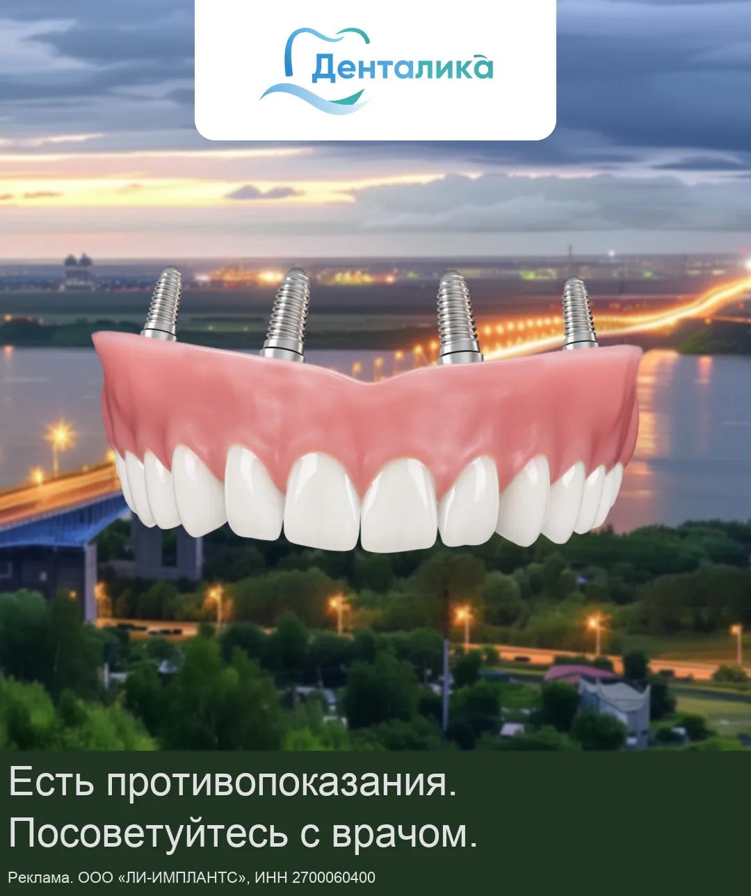 Все зубы за 1 день с несъёмным протезом на 4-х имплантах