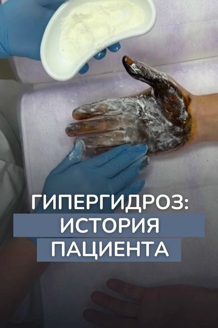 Повышенная потливость ладоней: как избавиться от проблемы

Пациент 24 лет обратился в клинику SALUS 