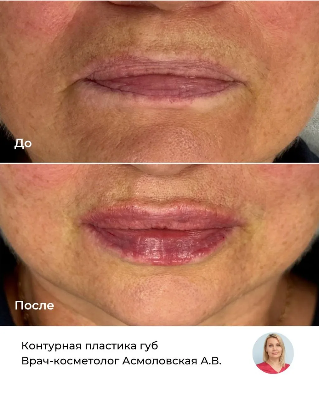 Результат контурной пластики губ от главного врача клиники, врача-косметолога Анастасии Викторовны А