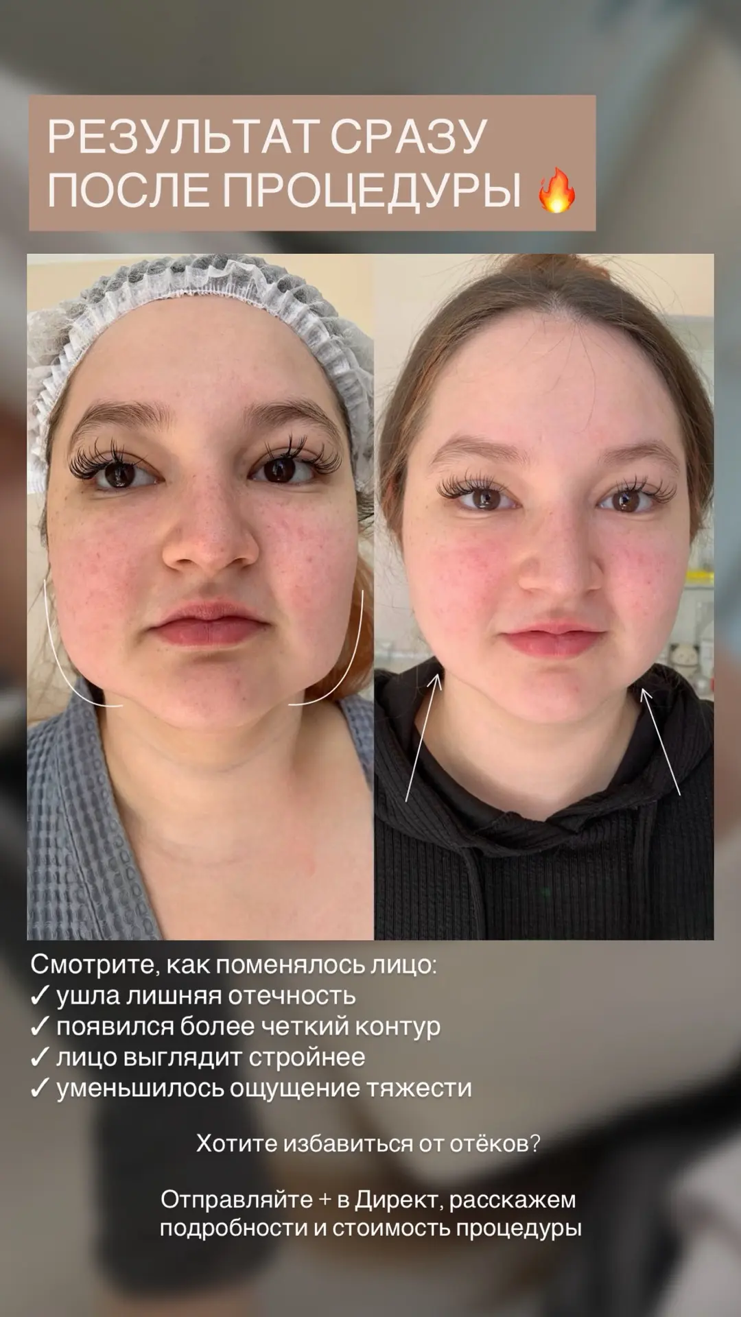 ЛУЧШАЯ ПРОЦЕДУРА ОТ ОТЁКОВ🔥

RF Forma - одна из самых эффективных процедур для подтяжки лица без ук