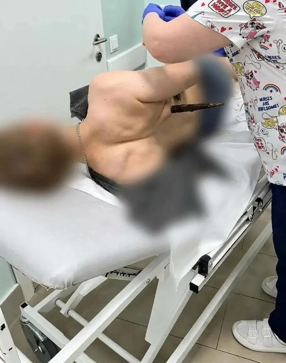 Врачи вытащили с того света парня с веткой в груди