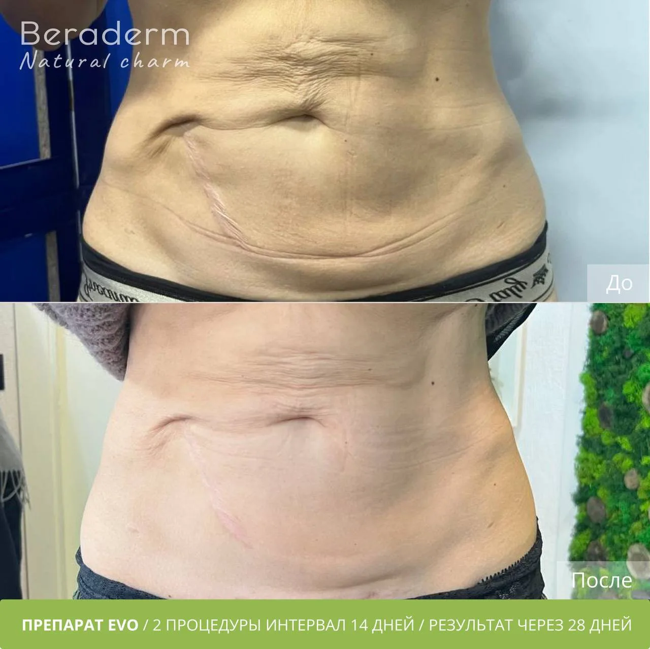 🌿 Beraderm EVO: Ваш идеальный союзник в борьбе с посткоррекционными изменениями! 🌿