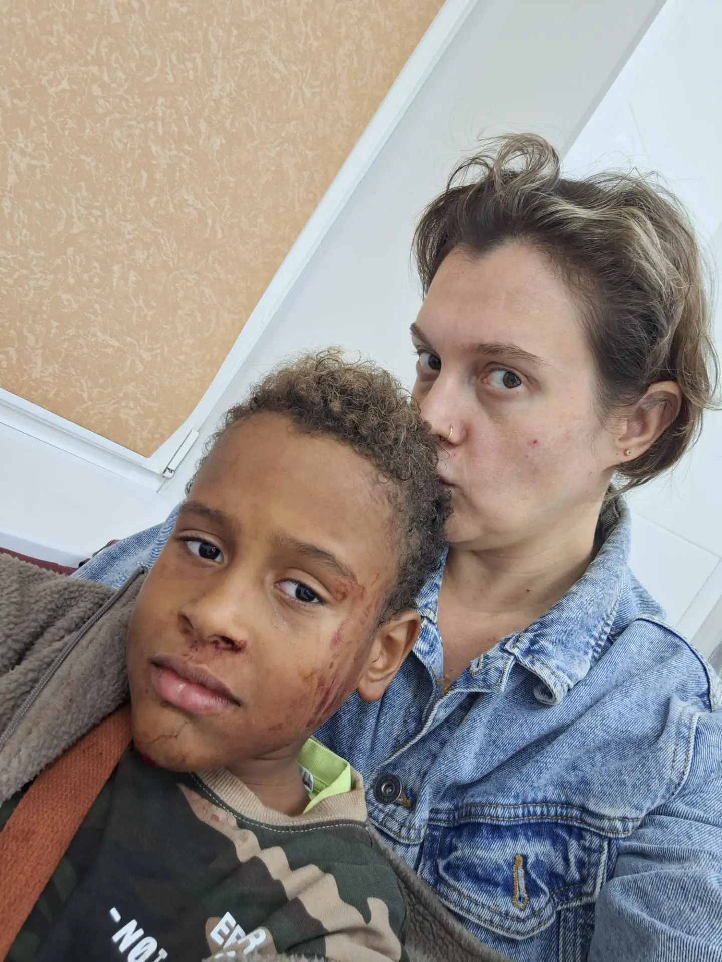 Зашили подбородок. Держался молодцом. Поплакал, конечно немного.