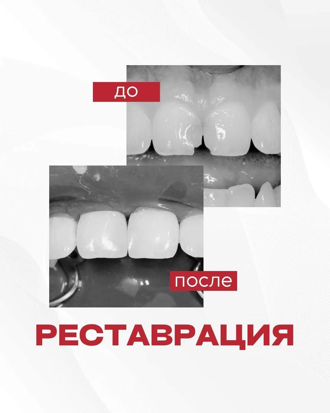 Пациент обратился с жалобой на скол зуба и нарушение эстетики улыбки.