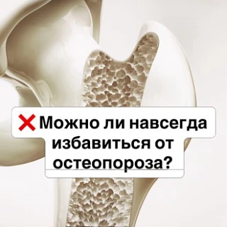 ❌ Можно ли навсегда избавиться от остеопороза? Разрушаем главный миф