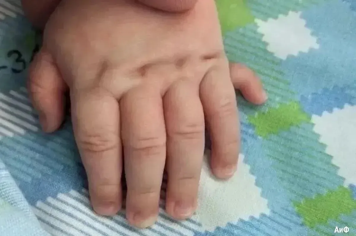 👩‍⚕️В Уфе родился ребёнок с шестым пальцем на руке