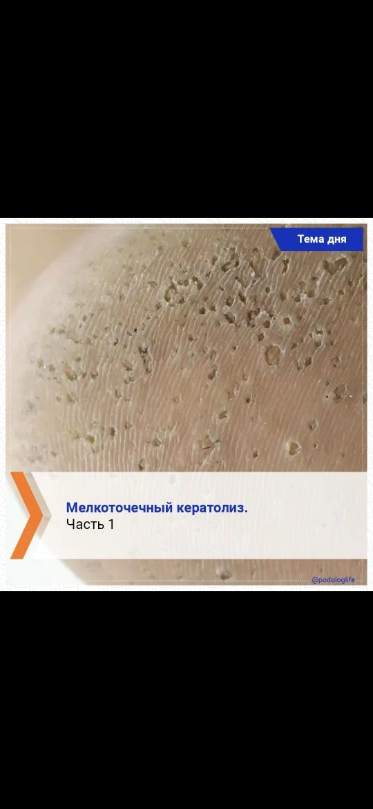 Мелкоточечный кератолиз.