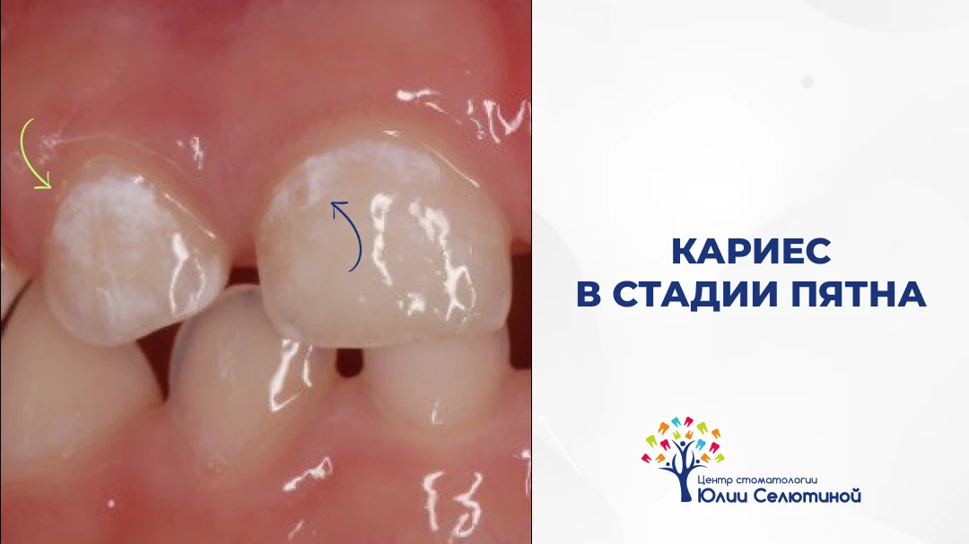 Как начинается кариес?