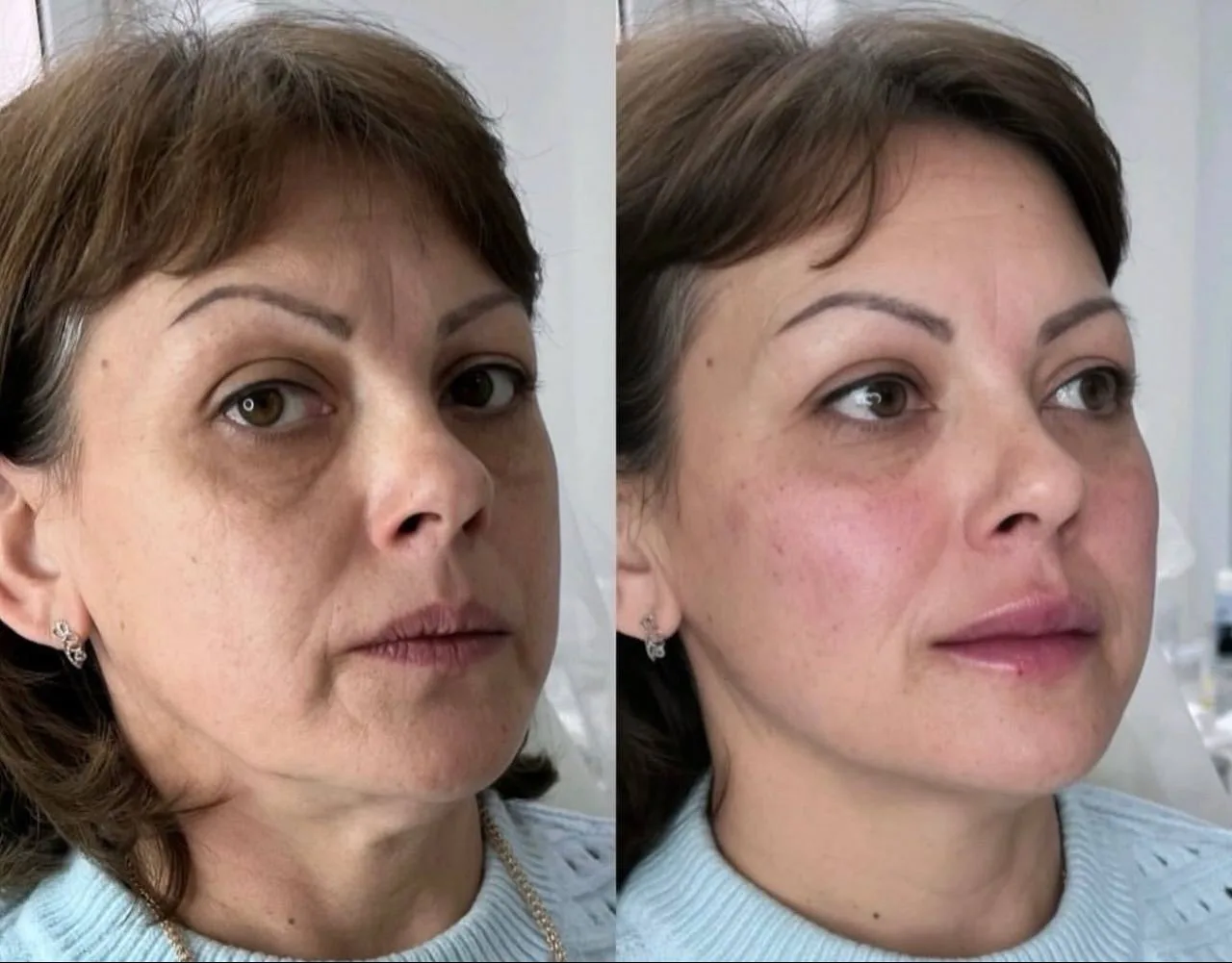 Девочки,здесь проведены 2 процедуры ❤️
Ботокс «Full Face»-7500,вместо 14000
Губы+носогубная складка-
