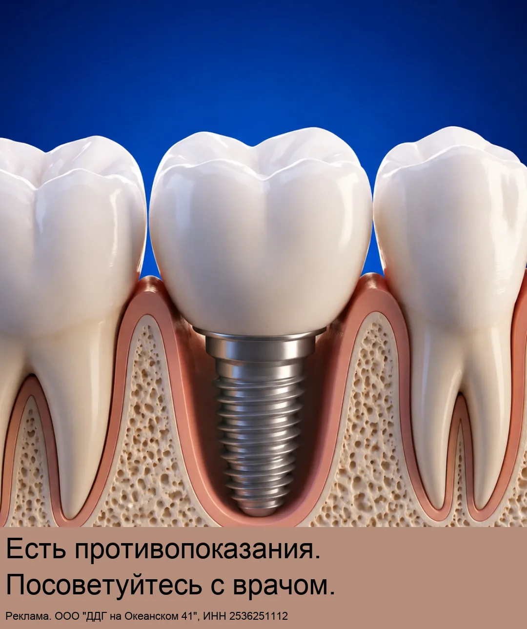 Имплант + работа врача от 20 900₽ по акции! Рассрочка 0%