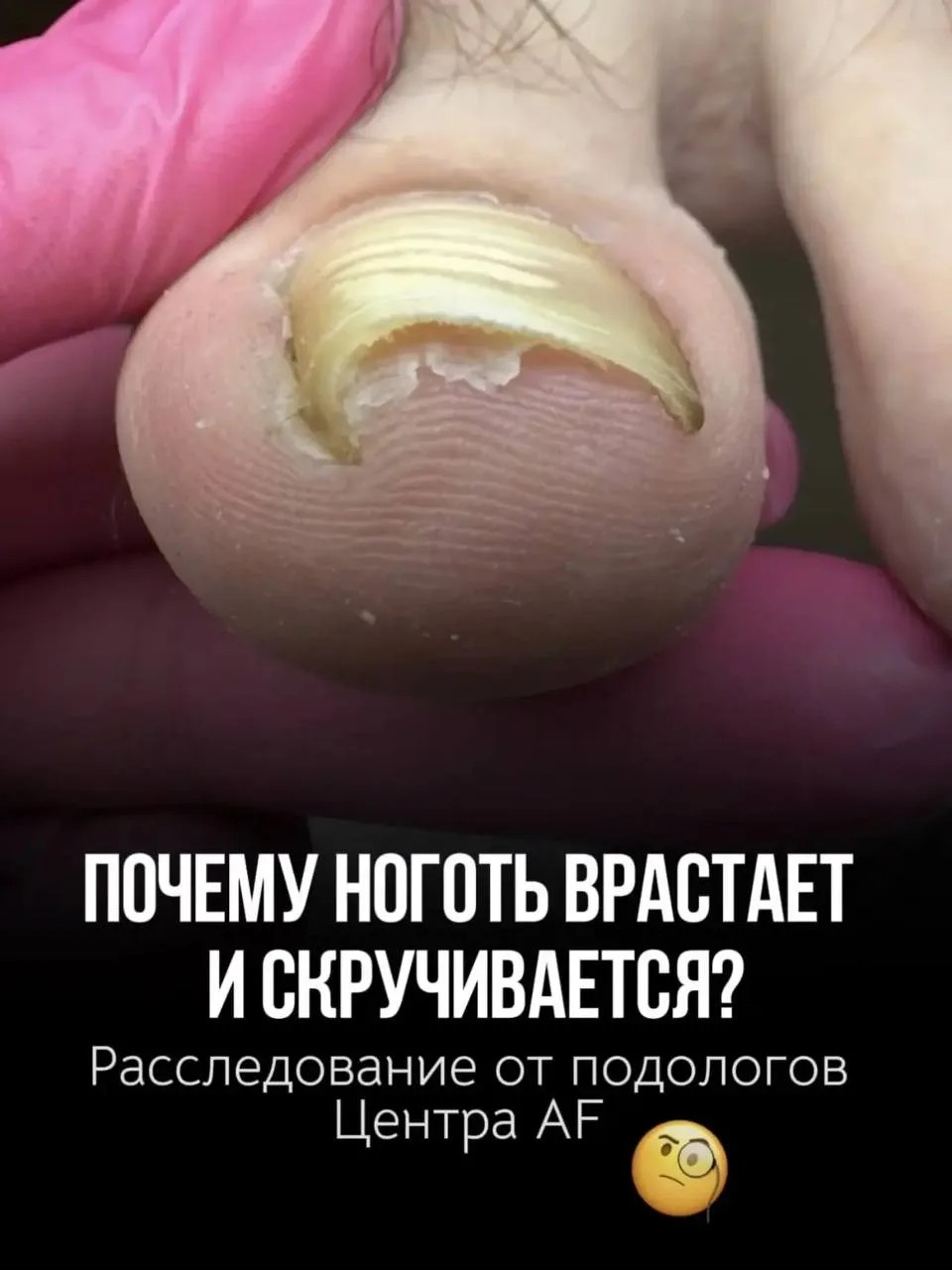 Ноготь очень редко начинает врастать или менять форму сам по себе!