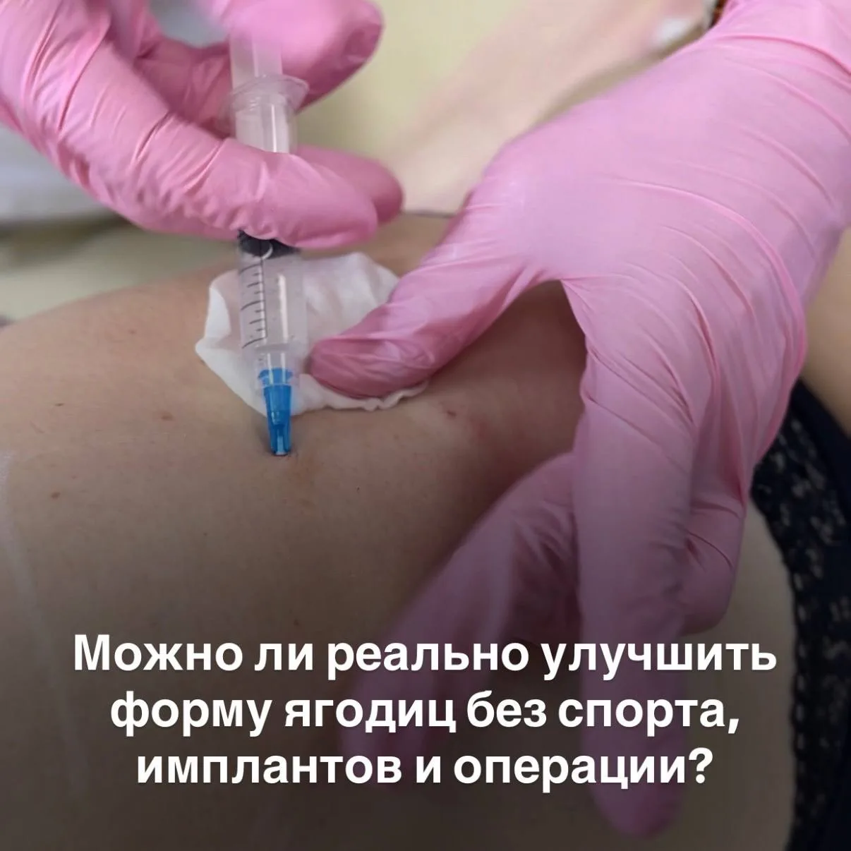 Можно ли реально улучшить форму ягодиц без спорта, имплантов и операции?