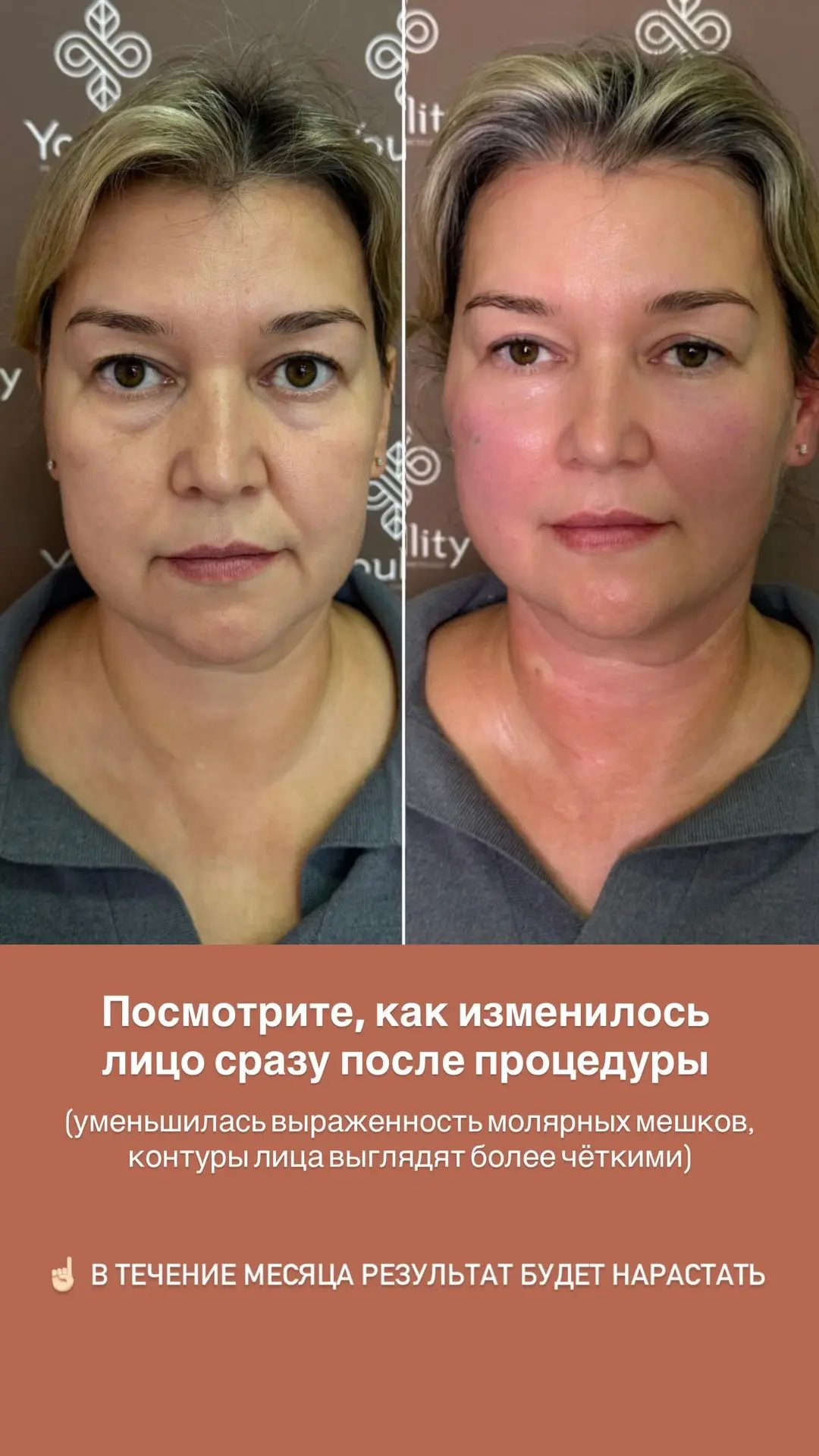 Деликатный лифтинг лица за одну процедуру - на слайдах показали процесс и результат 🔥