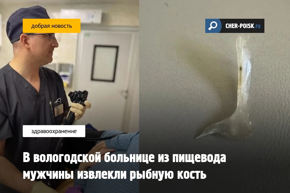 В вологодской больнице из пищевода мужчины извлекли рыбную кость  Пациенту назначили антибактериальн