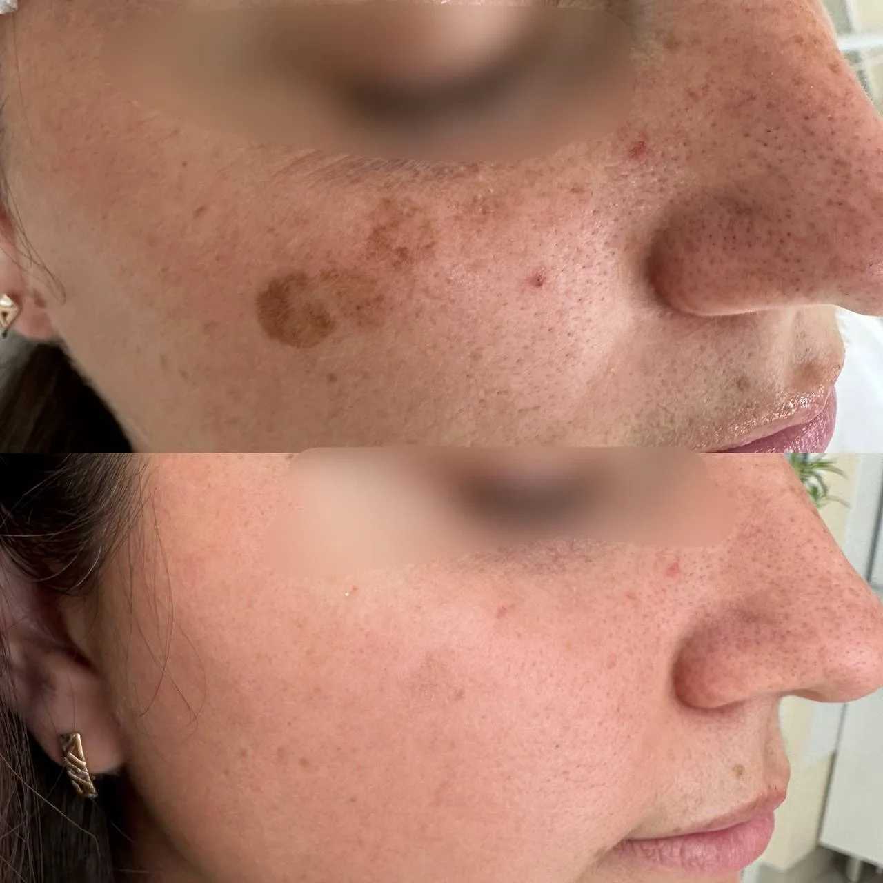 СОКРАТИЛИ ПИГМЕНТ ЗА 1 ПРОЦЕДУРУ 🔥

LUMECCA — одна из самых эффективных процедур фотоомоложения для