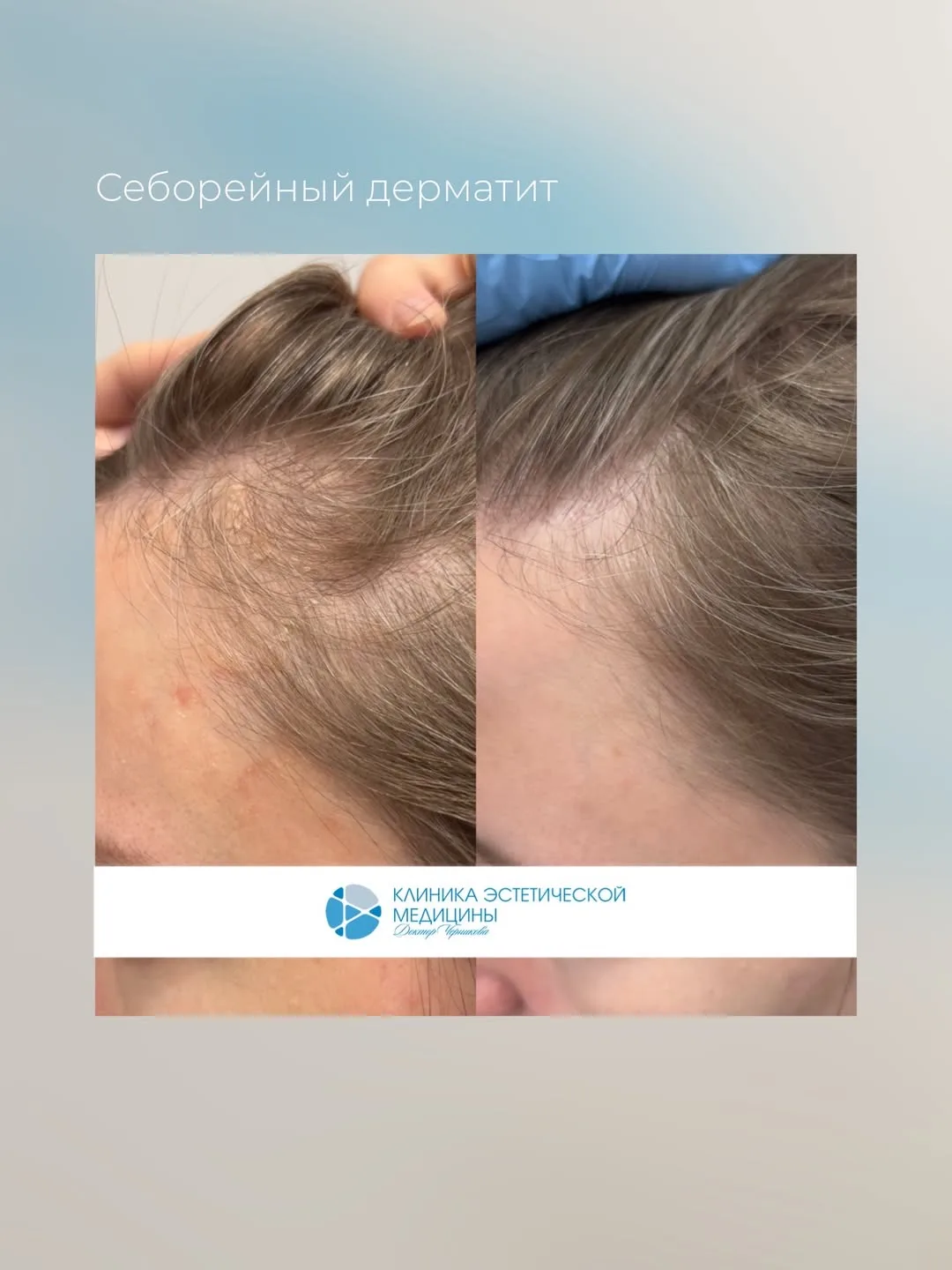 Зуд и шелушение кожи головы: когда пора к трихологу, а не в магазин косметики?👩‍⚕️