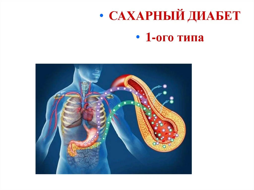 Сахарный диабет 1 типа (СД 1)- это заболевание, при котором поджелудочная железа перест...