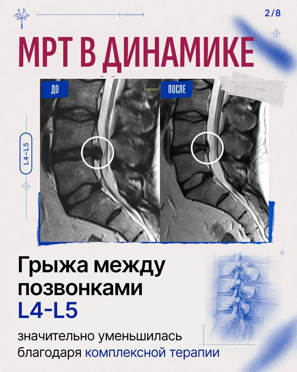 Крупная грыжа L4–L5 и 4 месяца боли, которая отдавала в ногу, мешала ходить, работать и...