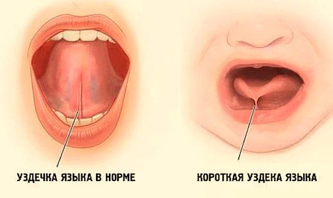 Пластика уздечки языка: кому нужна и для чего проводится?
 
Уздечка – это тонкий тяж слизистой оболо