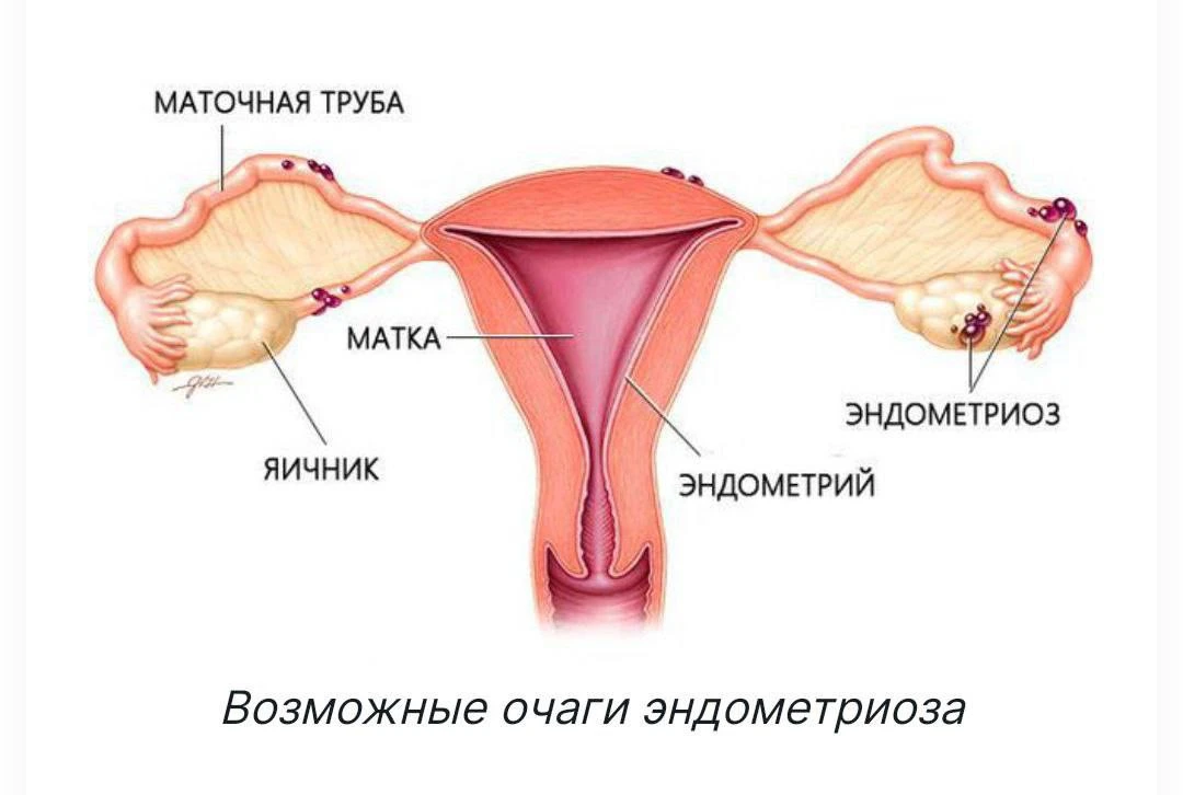Эндометриоз и гормонозависимые опухоли (миома матки, эндометриоз)

Эндометриоз — хроническое заболев