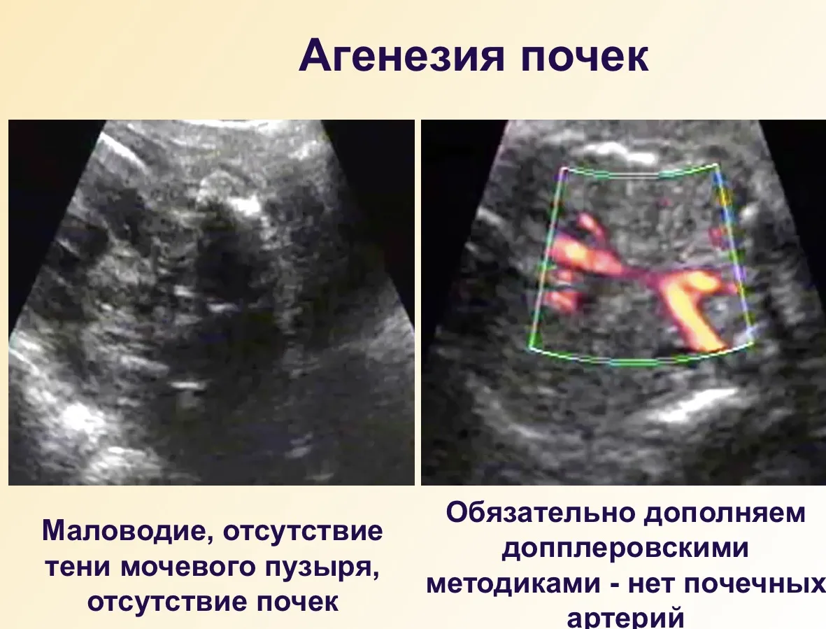 Клиническая задача: 31-летняя пациентка, 21 неделя 1 день беременности, прошла ультразв...