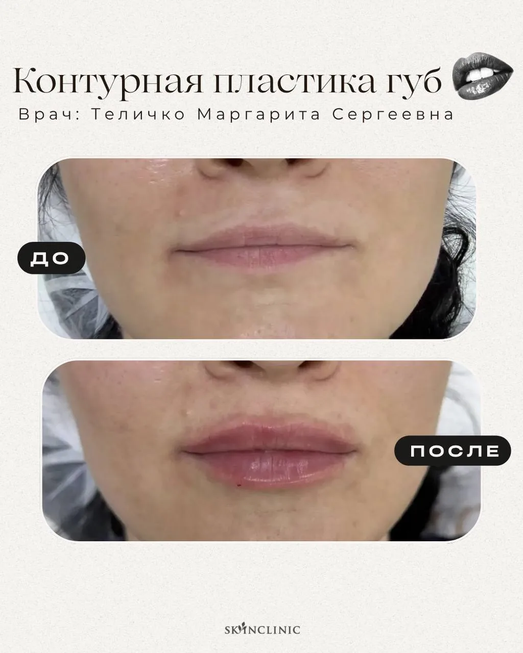 👄Результат после процедуры: контурная пластика губ