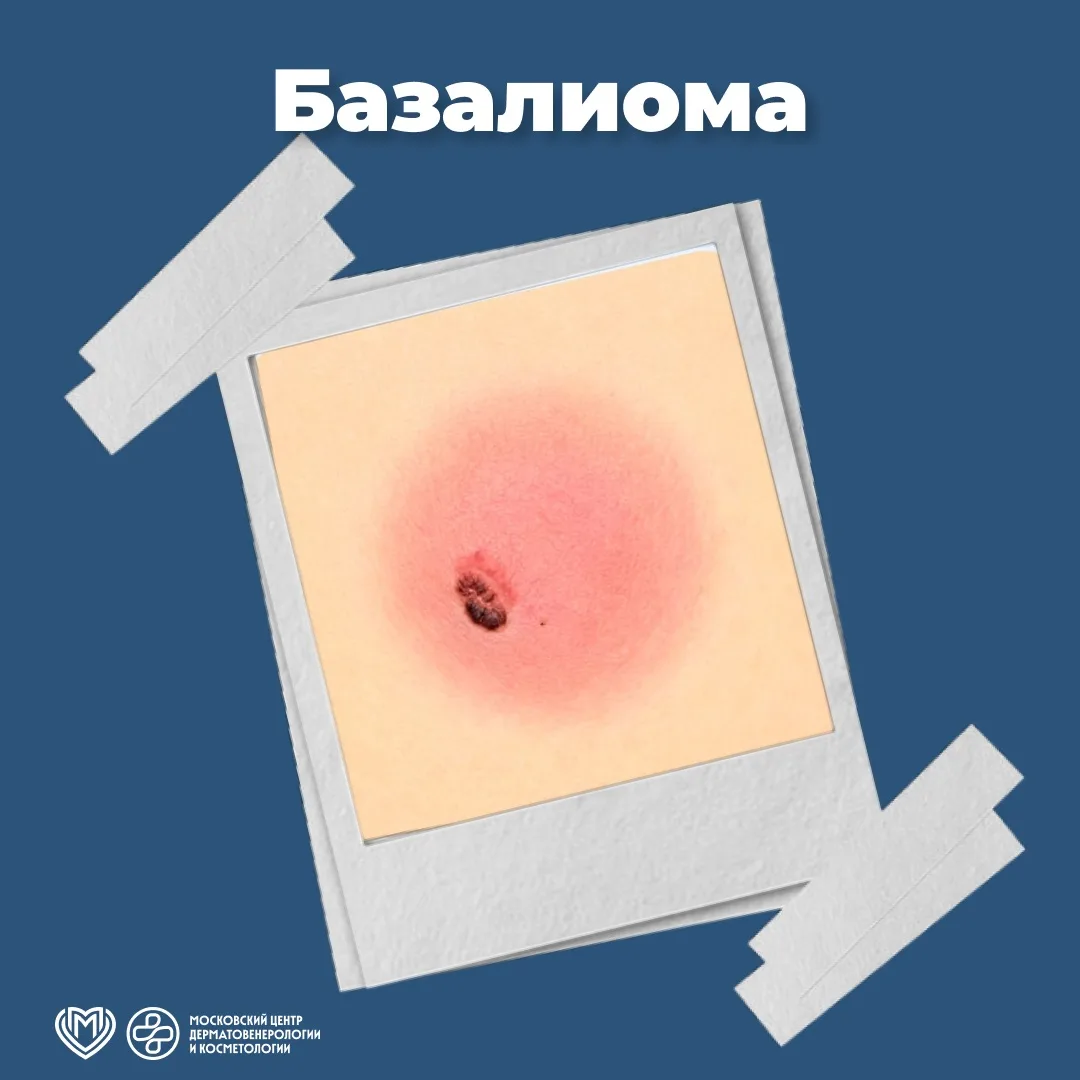 🔘 Базальноклеточный рак (БКР) – наиболее часто встречающаяся раковая опухоль кожи (45–...