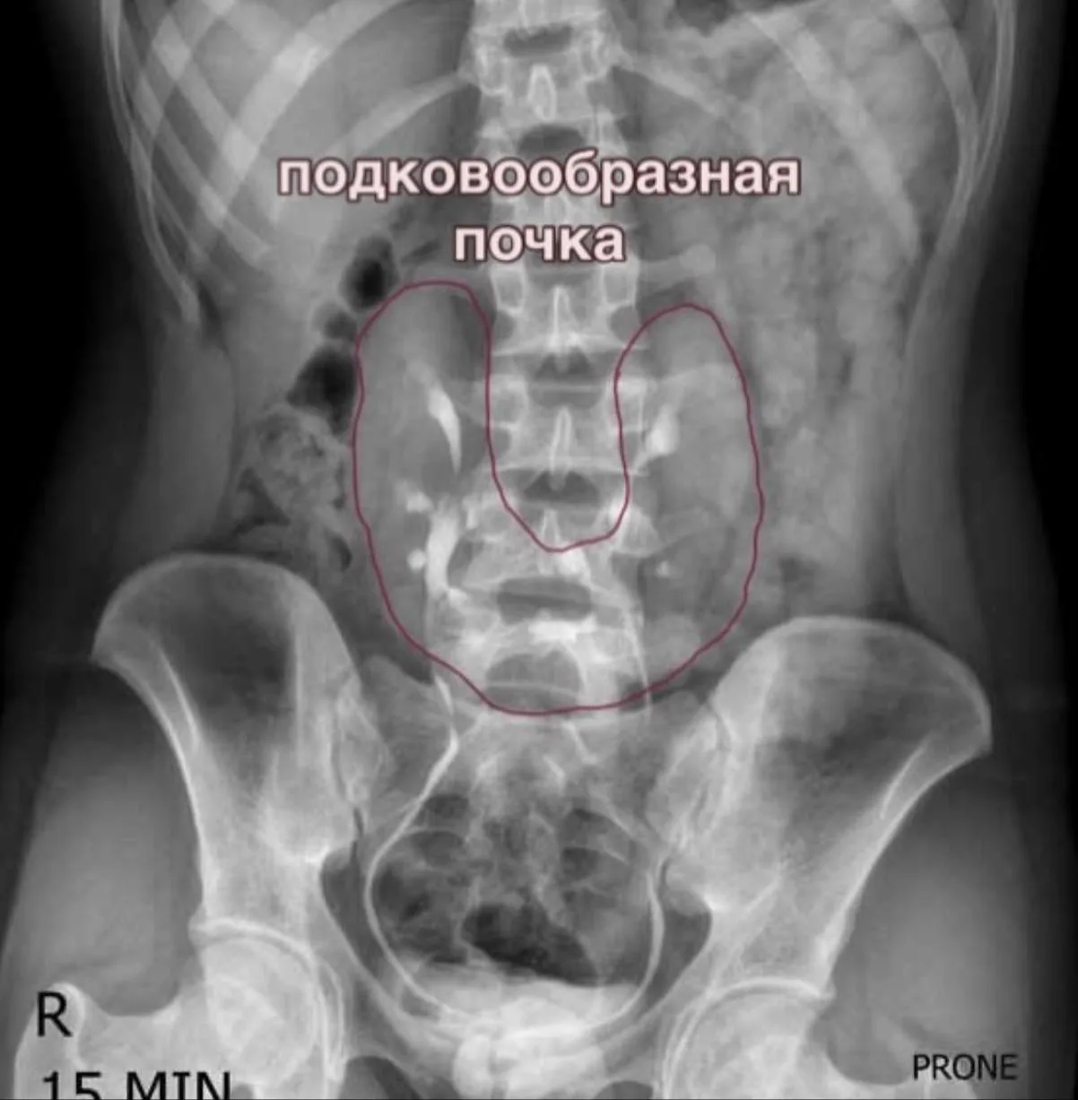 🔎 Что можно увидеть с помощью внутривенной и ретроградной урографии 

Материал заимствован. Источни