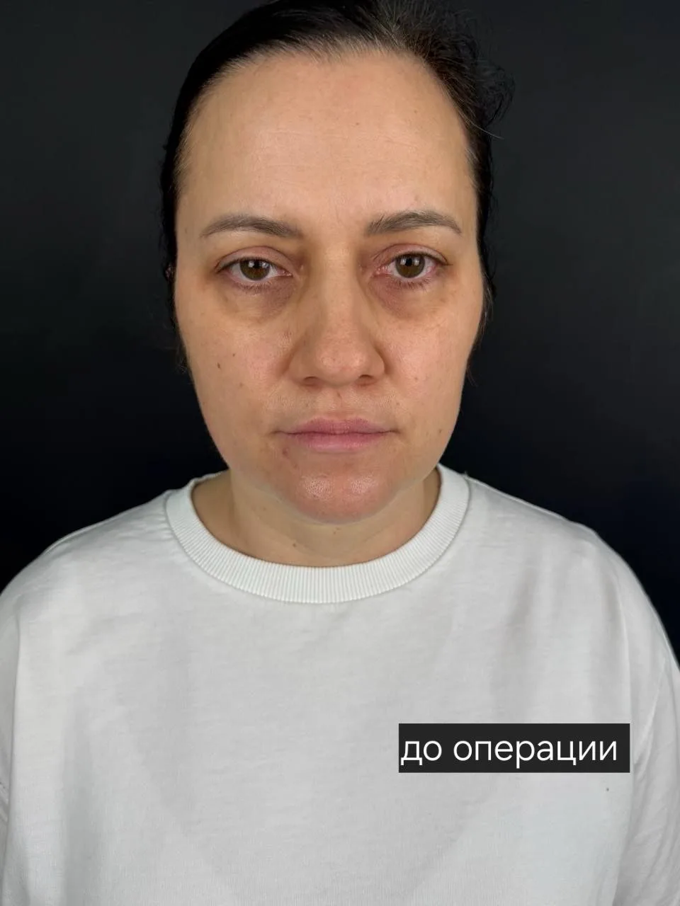 Когда вы присылаете свои фото - я всегда ценю это доверие🤍🤍🤍

3 месяца назад мы провели для пацие