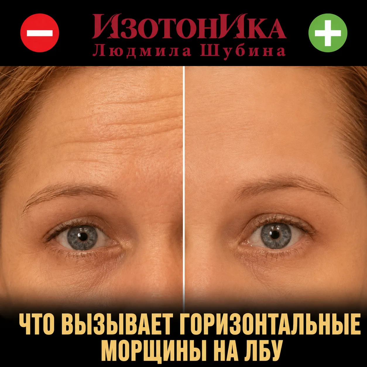 Сначала вы видите эти складки только когда удивляетесь и поднимаете брови. Через какое-...