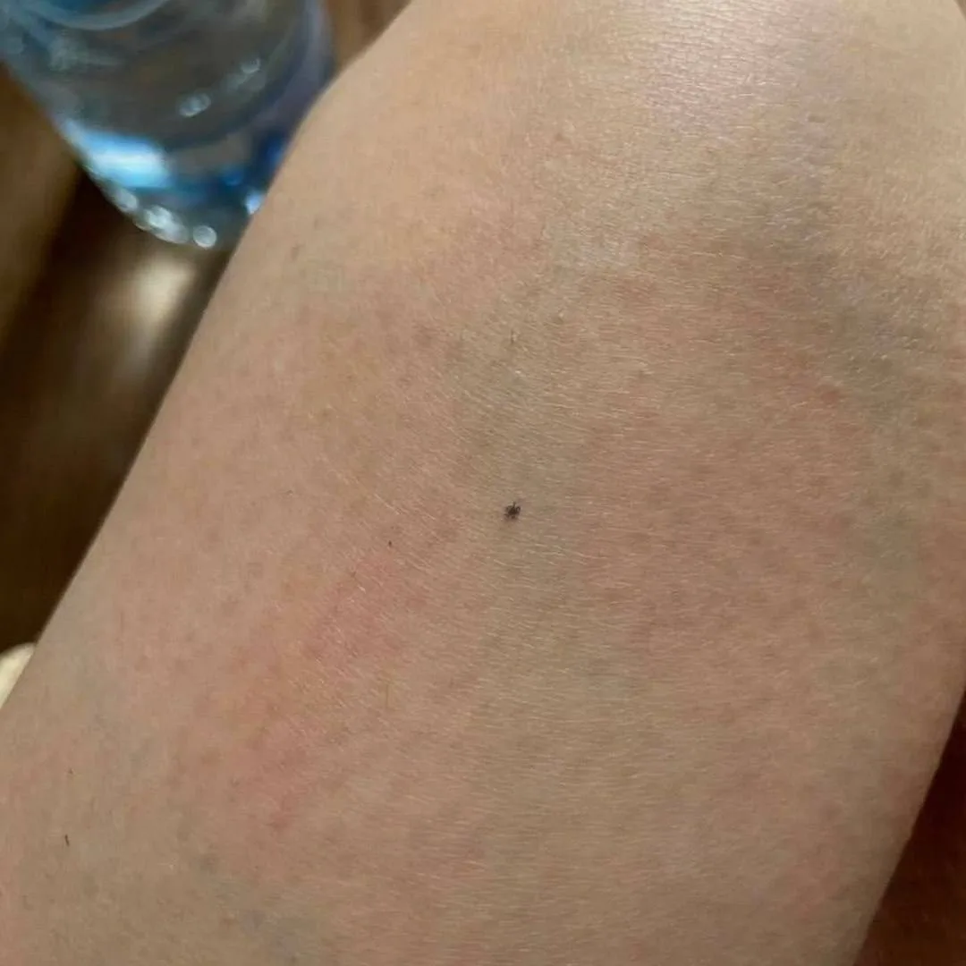 🕷️ В Татарстане ожидается вторая волна активности клещей