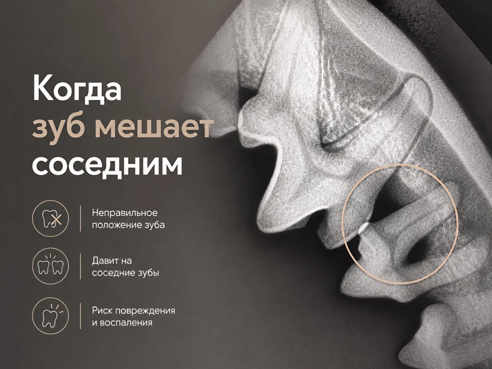 Зачем иногда удаляют один зуб, чтобы сохранить ближайшие