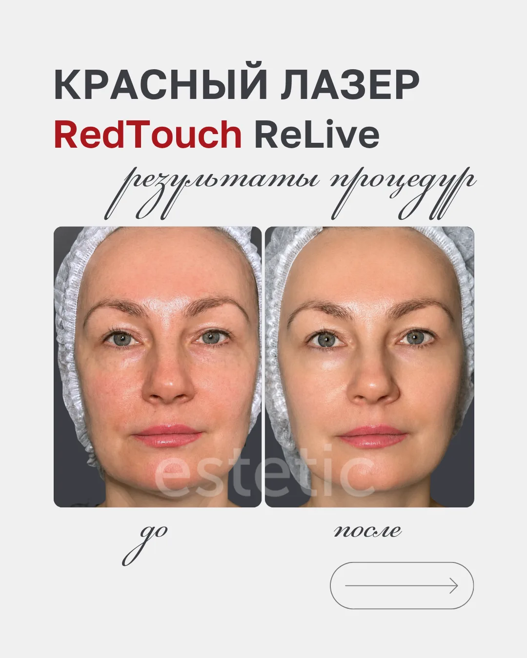 RedTouch ReLive — первый красный лазер нового поколения в Томске 💫  

Его особенность в том, что те