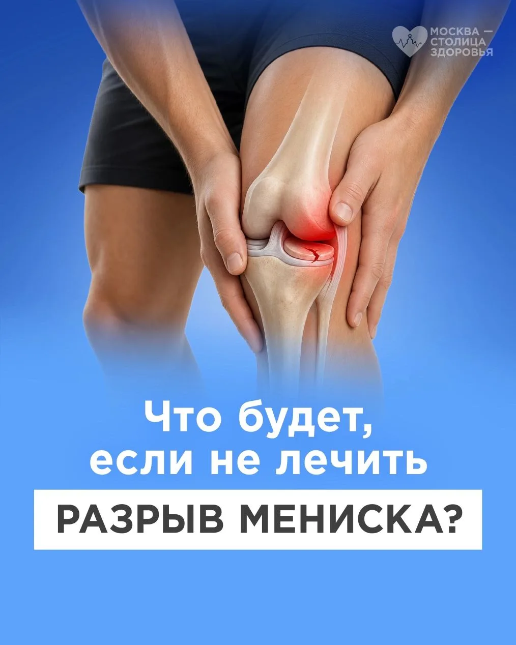Заблокированное колено: рассказываем все о застарелых повреждениях мениска 
 
❓Кто может столкнуться