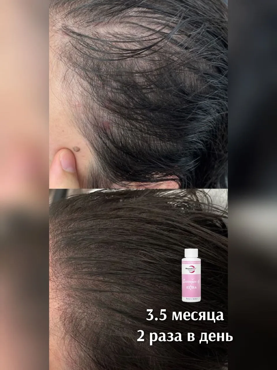 🌱Так должен выглядеть результат после 3-4 х месяцев использования лосьона

На примере изначально бы