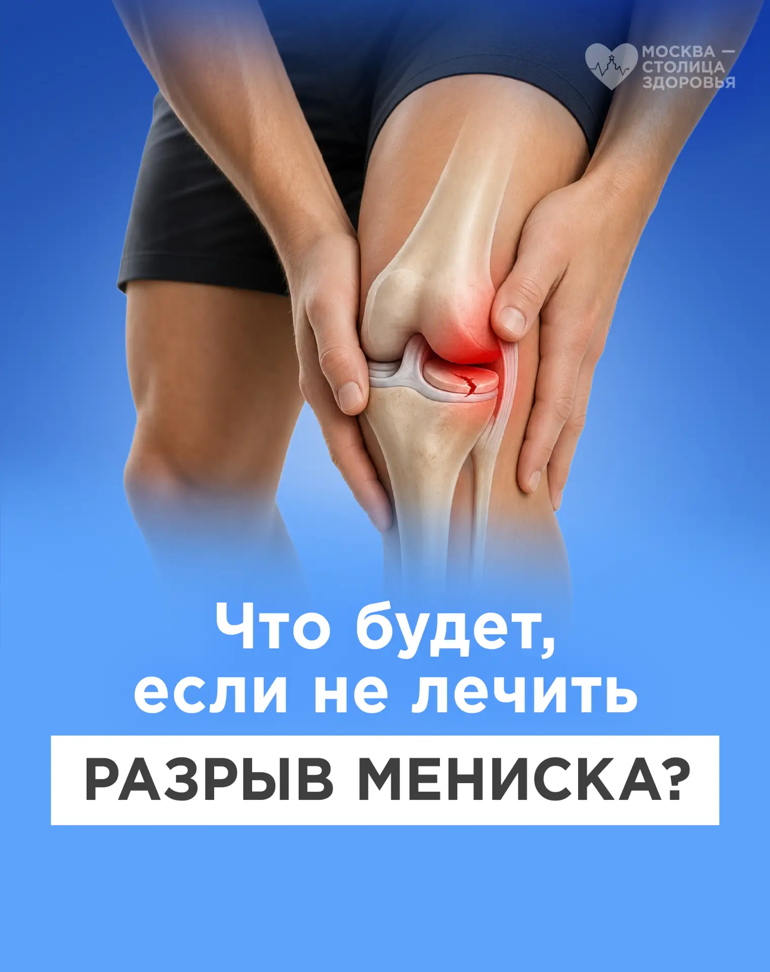 Заблокированное колено: рассказываем всё о застарелых повреждениях мениска

❓Кто может столкнуться с