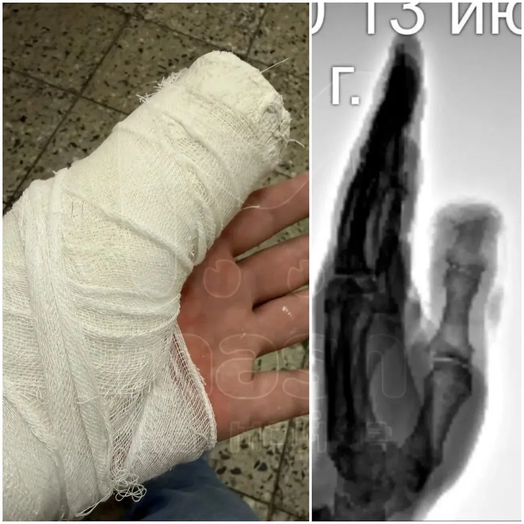 🦷 В Зеленогорске пенсионеру просто так частично откусили палец

Мужчина возвращался с вечера встреч