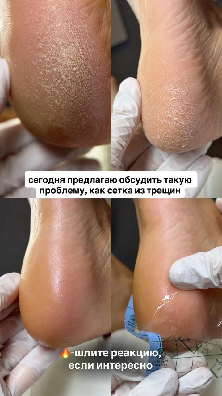 Сегодня предлагаю обсудить такую проблему, как сетка из трещин 👣