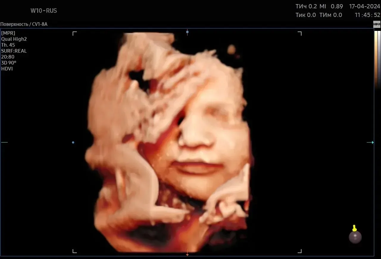 Современное 3D/4D УЗИ позволяет увидеть на экране мимику плода: ребенок умеет морщить н...