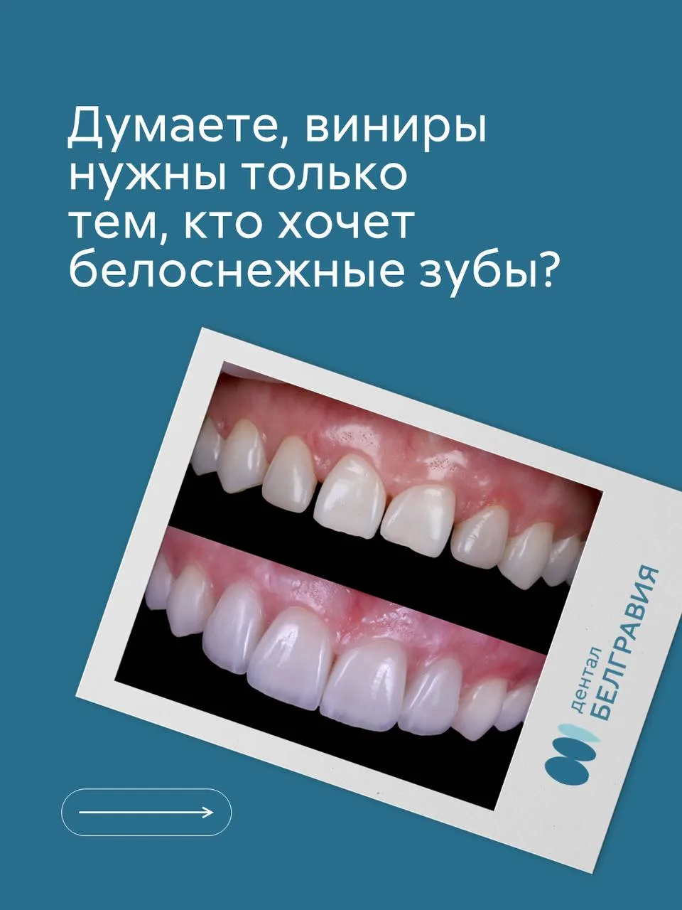 Иногда пациенты приходят к нам уже после завершения ортодонтического лечения, когда хочется доработа