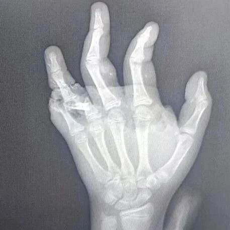 🧑‍⚕️ Липецкие врачи борются за сохранение кисти 13-летней девочки, которая пострадала при взрыве на