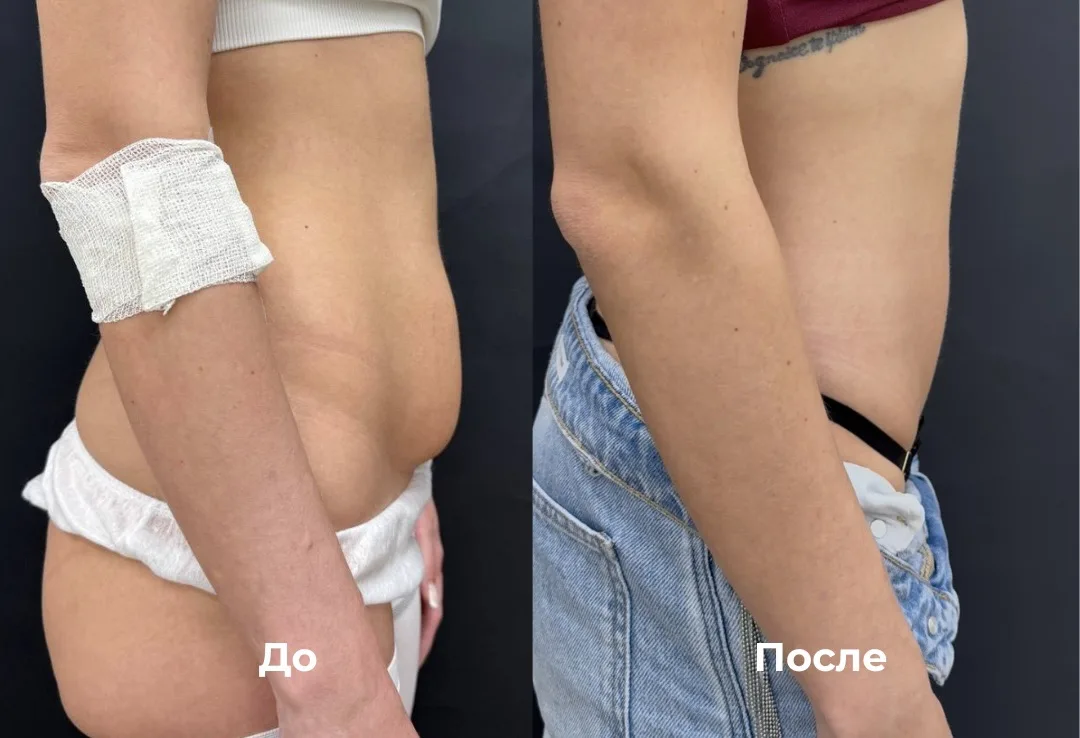 Абдоминопластика и липосакция живота, выполненная пластическим хирургом Сергеенко Андре...