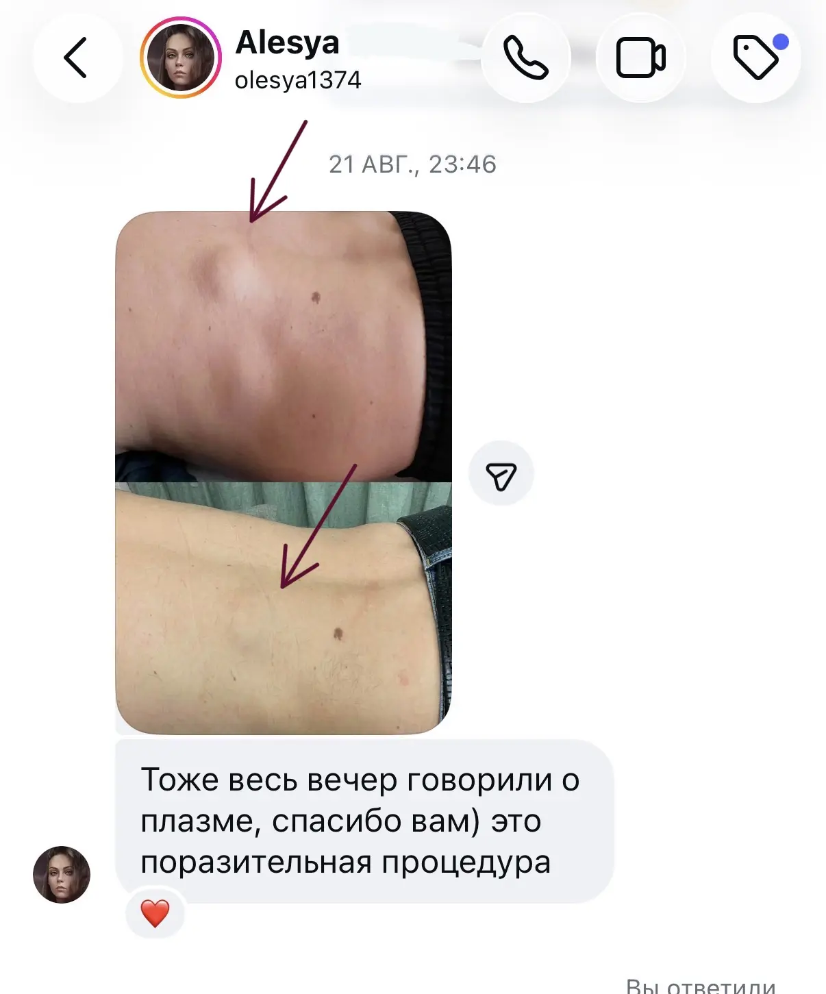 Холодная плазма при атеромах, гигромах и липомах
