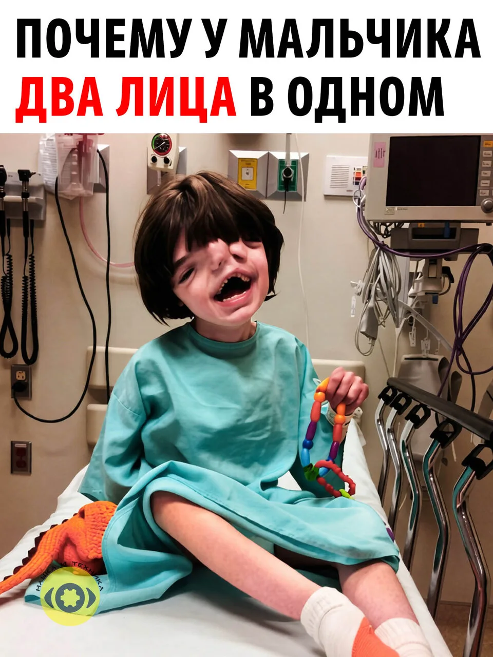 Черепно‑лицевое дублирование, чрезмерное количество белка SHH провоцирует разрастание л...