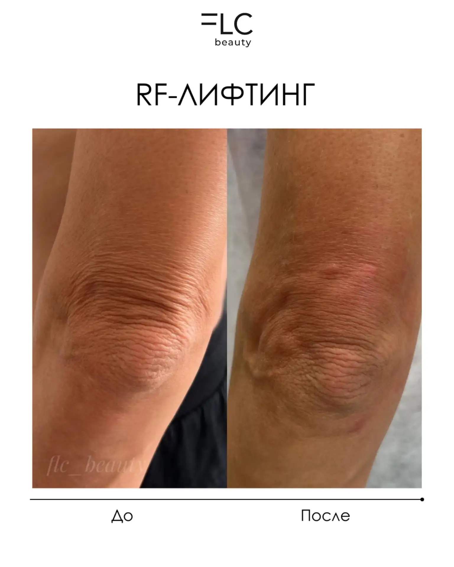 RF-лифтинг: колени и локти

RF‑лифтинг — современная процедура, которая стимулирует выработку коллаг