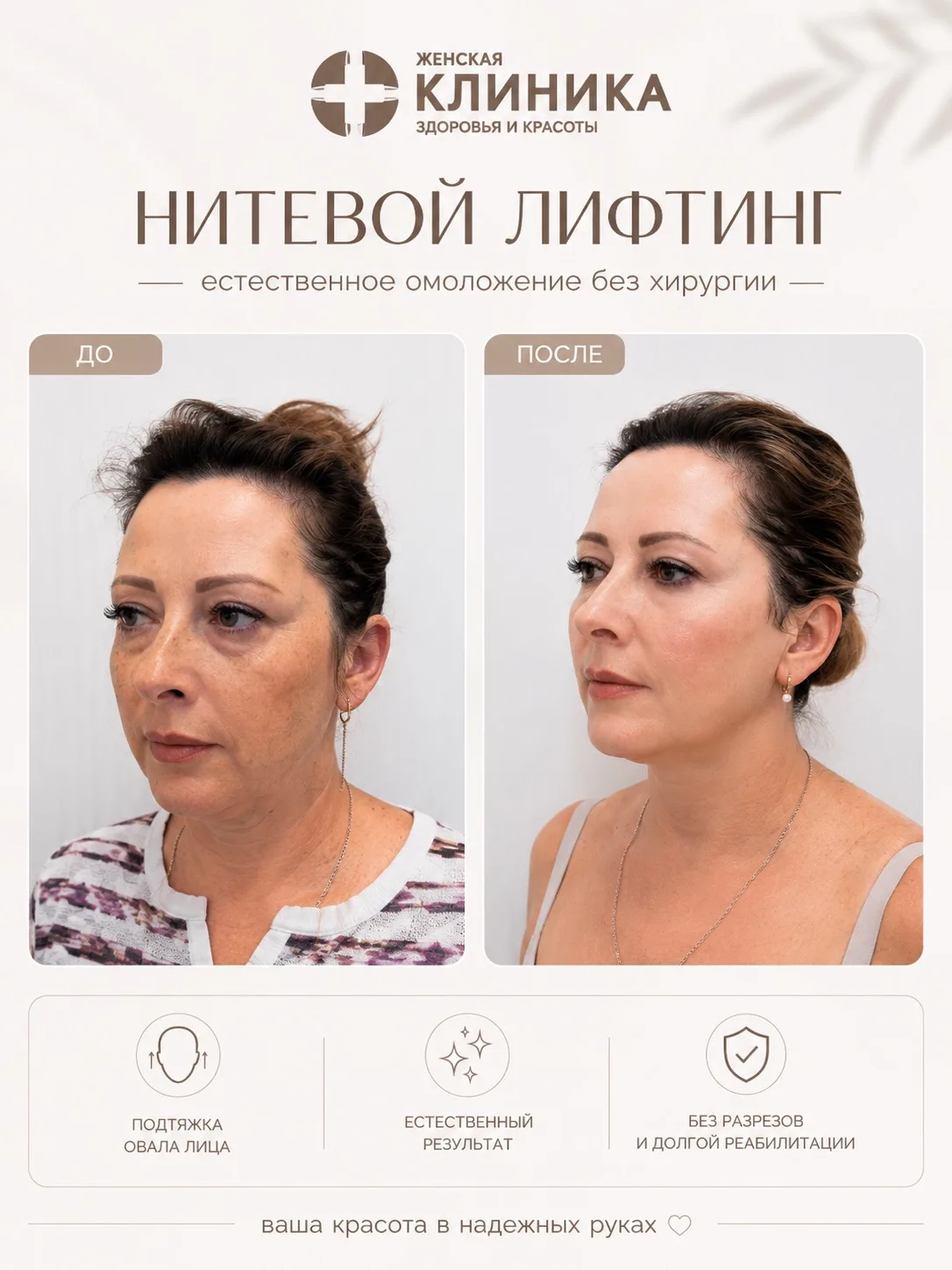 Нитевой лифтинг — это не про кардинально другое лицо.